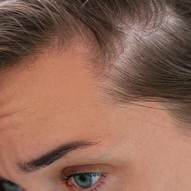 What Vitamin Deficiency Causes Hair Loss?
