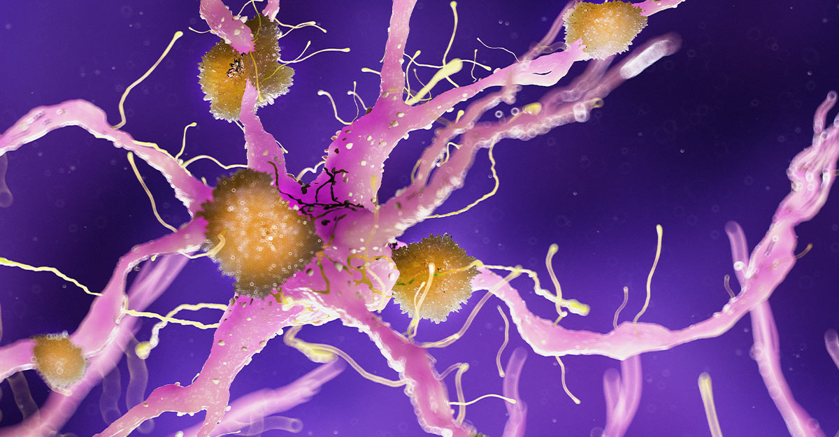 Poor Sleep and Alzheimer’s Disease