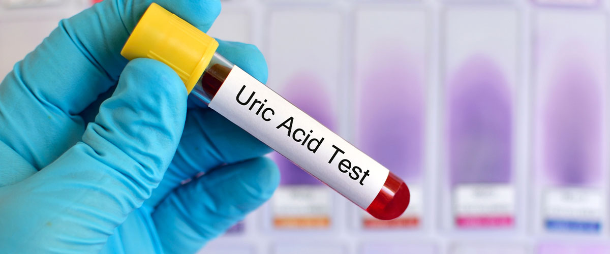 Uric Acid as a Marker for Cardiac Risk