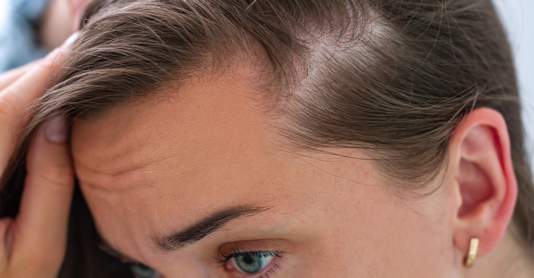 What Vitamin Deficiency Causes Hair Loss?